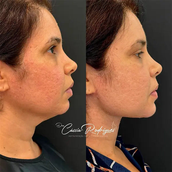Resultado antes e depois 1